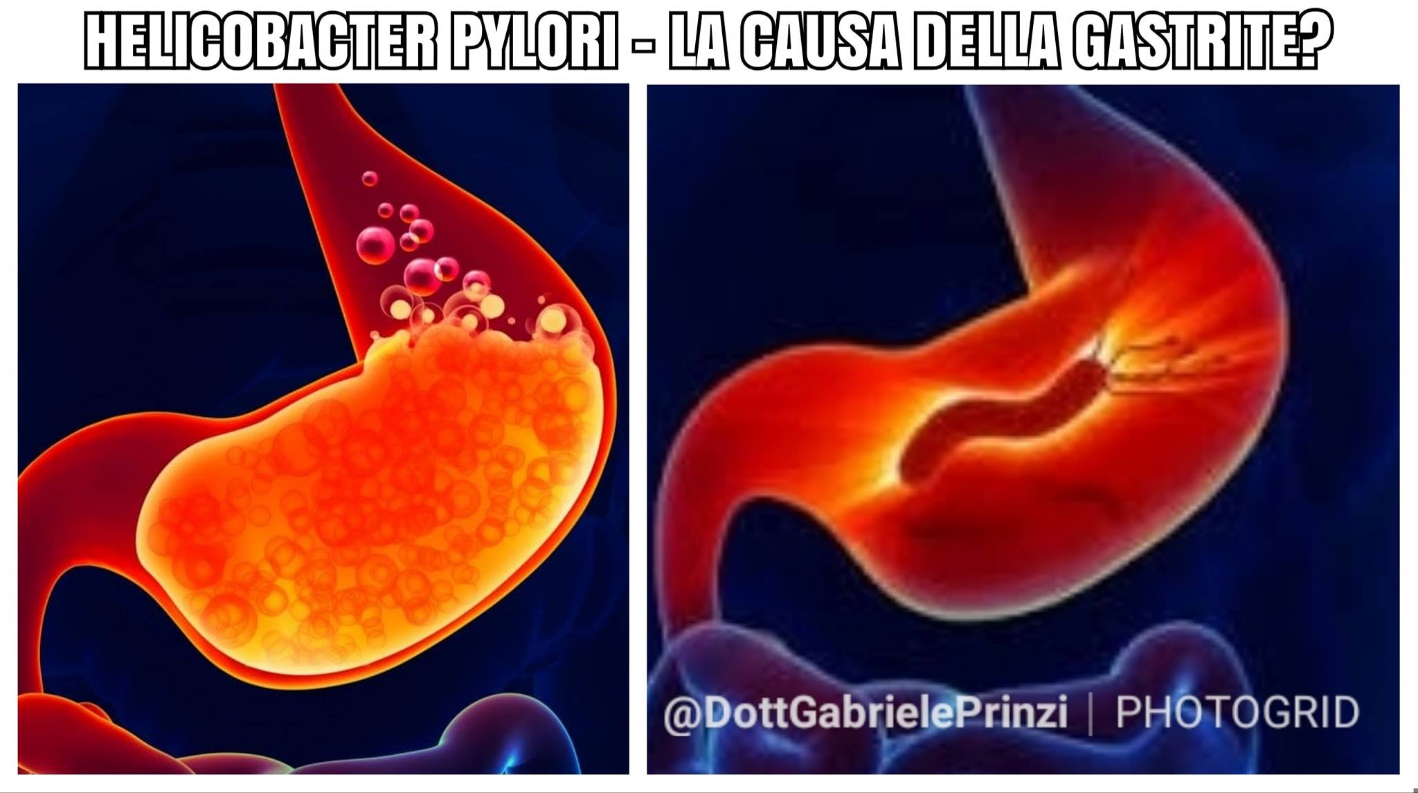 Ma è davvero tutta colpa dell'Helicobacter o ci nascondono qualcosa?