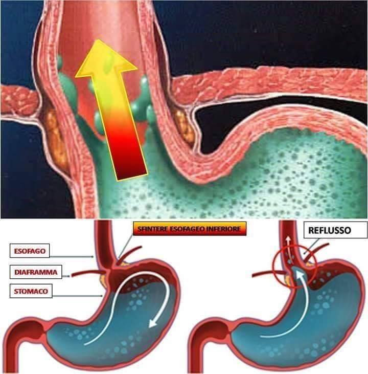 Bruciori di stomaco, Perché?