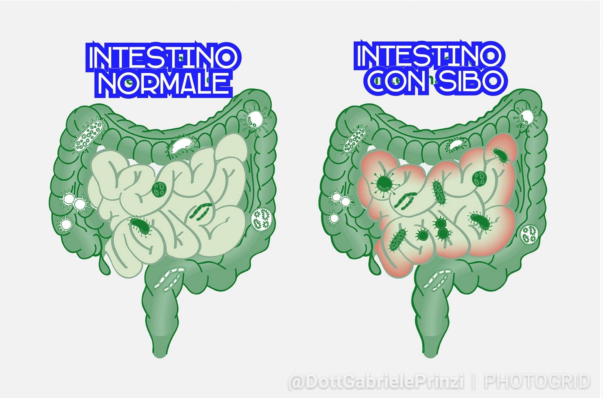 Intestino Irritabile e "S.I.B.O." Come la Disbiosi spiega la "sindrome"!