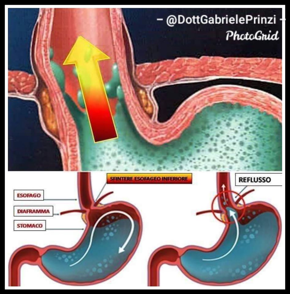 Gastrite… Reflusso… O cosa? Rischi per la salute e per la deontologia.